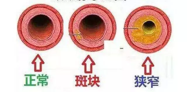 30歲後血管一年比一年堵,每天做到「三勤」,活到80也不得腦梗