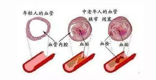 30歲後血管一年比一年堵,每天做到「三勤」,活到80也不得腦梗