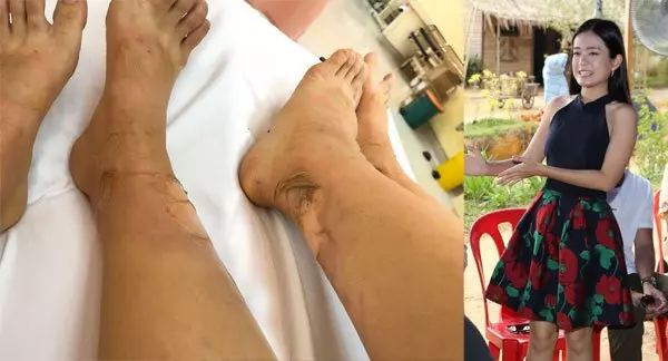 楊盼盼燒傷臉 梁祖儀雙腿三度灼傷