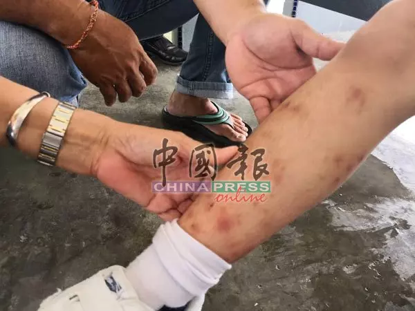 怪蟲襲擊華小 20師生全身紅腫痕癢