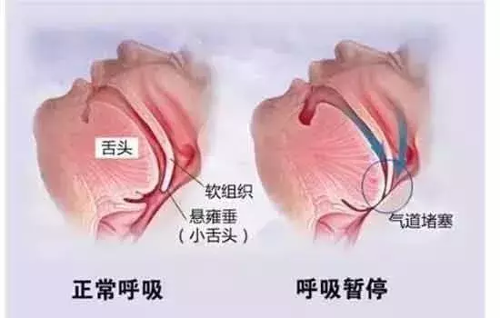 你是否被打鼾困擾著?打鼾是病嗎?我們又該如何預防?