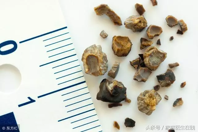 結石的產生,與水質息息相關,這些因果關係弄明白了嗎?