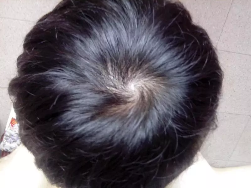 為什麼有人頭上只有一個旋，有人卻有兩個？看完漲知識了！ 