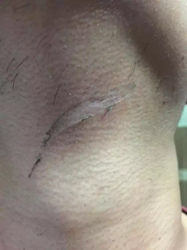 【網友:頸項差點被割斷!】不法之徒在Gombak轉彎處綁魚線,男網友經過被割傷脖子!
