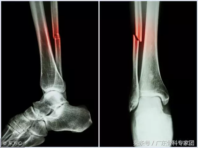 為什麼有人很容易就骨折?骨折的原因了解一下