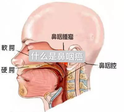 認識什麼是鼻咽癌?