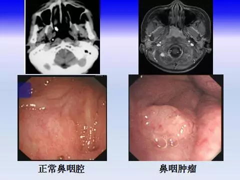 認識什麼是鼻咽癌?