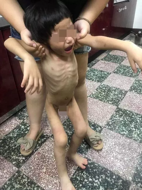 3歲男童遭虐骨瘦如柴 被綁陽台吞排泄物 | 東方網 | 馬來西亞東方日報