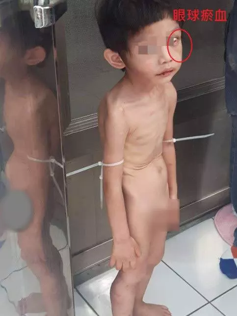 3歲男童被親生爸爸+同居女友綁在家裡吃屎!媽媽探視才驚覺男童瘦剩皮包骨也全身是傷……