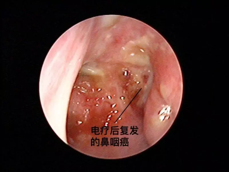 【李宗偉患癌】什麼是鼻咽癌?如發現有這7個症狀,你就要注意了!