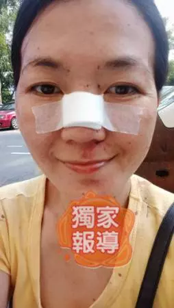 老婆講錯一句話 老公揮拳 斷鼻樑