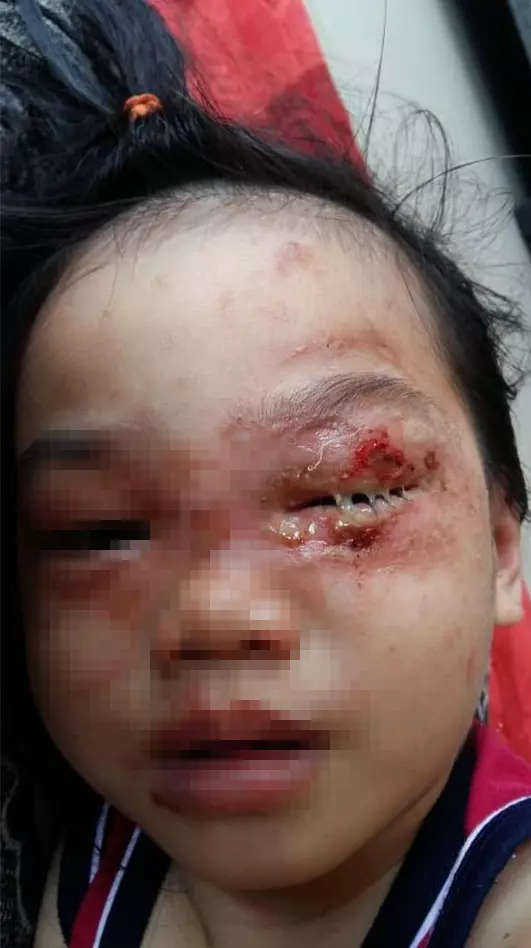 小孩碰觸「毒液」導致眼睛紅腫流膿 媽媽貼心發文促注意