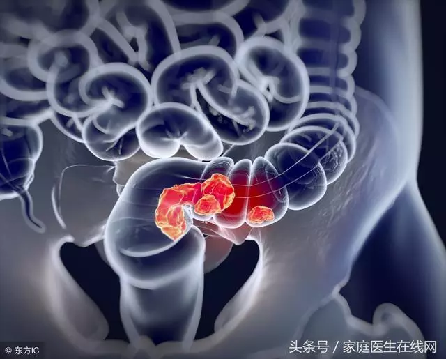 為什麼很多人都得了結直腸癌?醫生慢悠悠地說了這些秘密