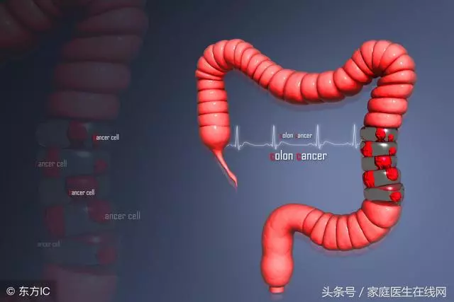 為什麼很多人都得了結直腸癌?醫生慢悠悠地說了這些秘密