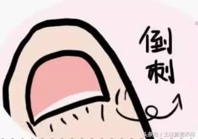 手指上有倒刺,您可以別再直接撕掉,已經有人因此而截掉手指