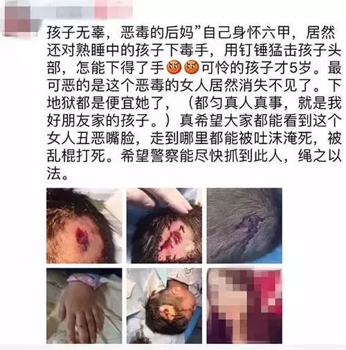 (氣憤!5歲男童熟睡中竟被爸爸懷孕女友毒打,鎚子猛擊,傷口深見頭骨!)