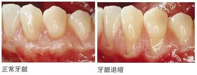 牙齦退縮,牙根暴露,不敢刷牙怎麼辦?