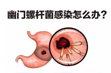 幽門螺桿菌危害有多大?如何判斷幽門螺桿菌是否被消滅乾淨了?