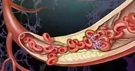 離死亡最近的動作,毀血管、傷膝蓋、致老痴……比抽菸酗酒還危險!