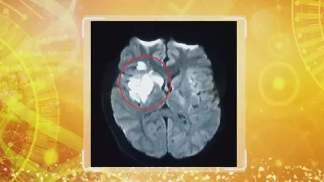 18歲男孩突發腦梗,竟是因為有「心眼」!很多人都有,只是不知道