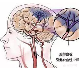 補充這種物質,可以大幅度降低腦梗塞的發病率!您補充了嗎?