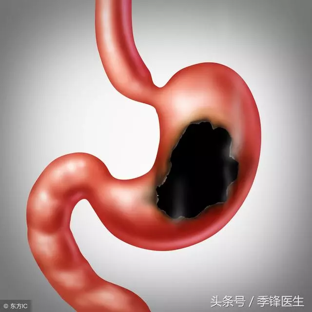 胃潰瘍的主要病因是什麼?得了胃潰瘍應該怎麼治療?