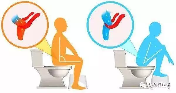 協和專家告訴您:上廁所是坐馬桶還是蹲著好?
