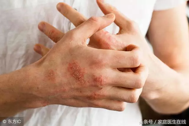 學會這3招,不怕濕疹反覆發作,還你光滑細膩的皮膚