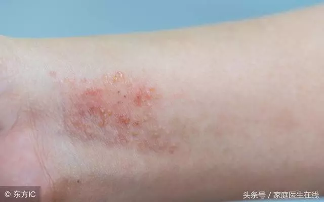 學會這3招,不怕濕疹反覆發作,還你光滑細膩的皮膚