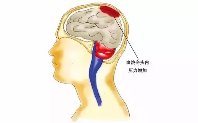 腦血管崩潰前有10個信號,大部分人都忽略了
