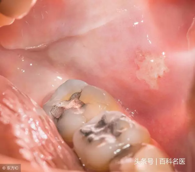 你是橫著刷牙還是豎著刷牙?橫著刷會導致這3種疾病,你還不改嗎
