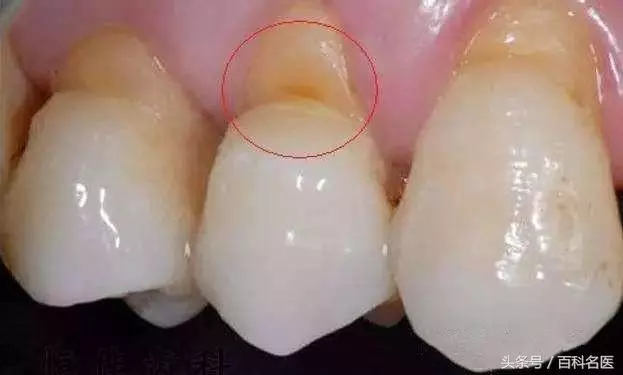 你是橫著刷牙還是豎著刷牙?橫著刷會導致這3種疾病,你還不改嗎