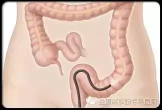 炎症性腸病的飲食注意事項!