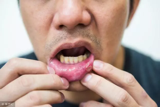 口腔潰瘍久治難愈,關鍵「七分養」,做好5件小事能預防!