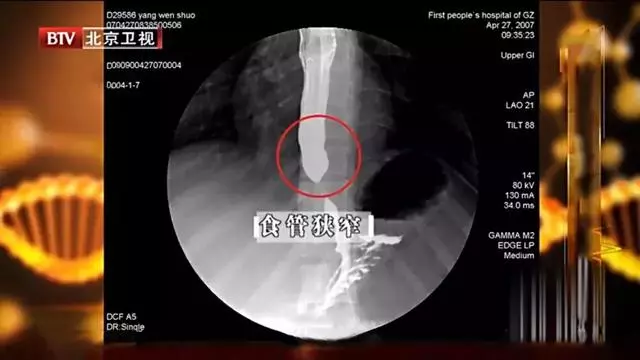 食物入胃之前先要經過它!吃得太燙,小心惹上腫瘤危機