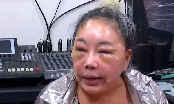 一天要28次 富婆臉整成豬頭
