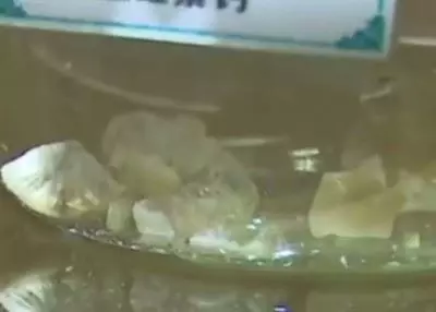 老婦體內取出221粒膽結石 原因竟是長年吃素?