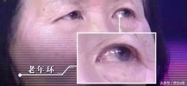 血脂高,臉先知,多食「3物」,多喝3水,少做3事,可防血栓!