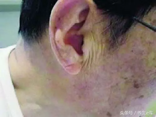 血脂高,臉先知,多食「3物」,多喝3水,少做3事,可防血栓!