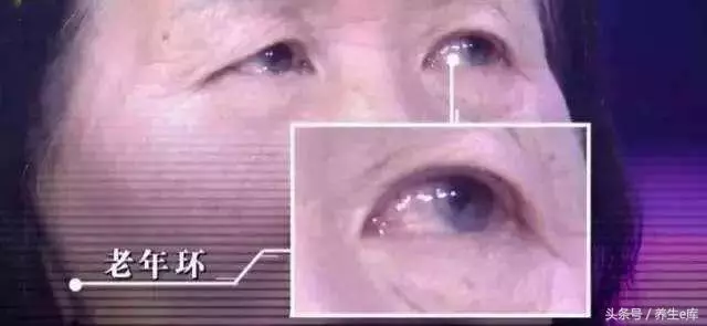 不論男女,臉上若有5種變化,小心高血脂!3樣食物再想吃也要忍忍