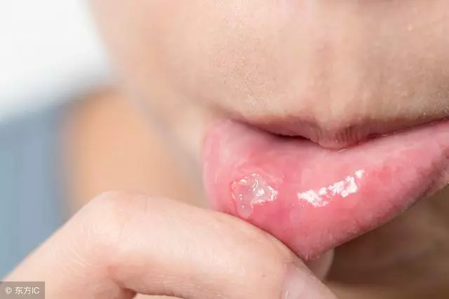 口腔潰瘍頻繁發作是什麼原因?哪些情況的口腔潰瘍要及時就醫?