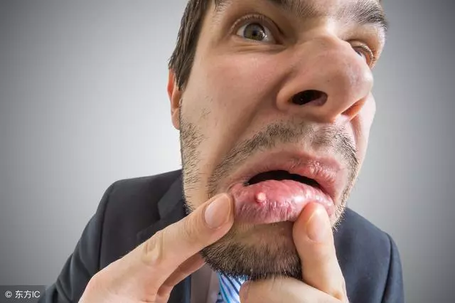 口腔潰瘍頻繁發作是什麼原因?哪些情況的口腔潰瘍要及時就醫?