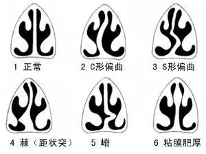 嬰幼兒鼻塞有什麼辦法?