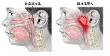 嬰幼兒鼻塞有什麼辦法?