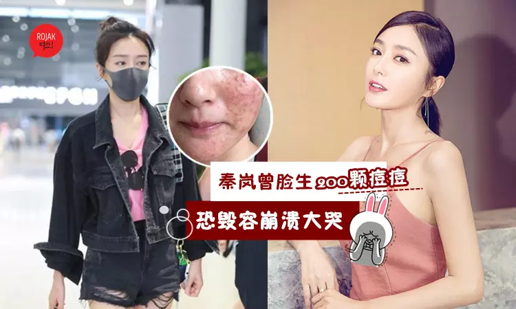 怎麼可能?!『皇后秦嵐』曾全臉冒200顆痘痘.爛臉崩潰大哭!網友:完全看不出!
