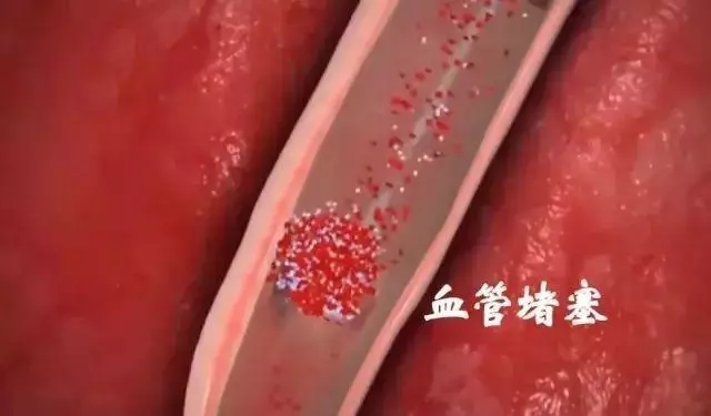 血管堵塞的真兇找到了!醫生建議:堅持3點,血管越來越通暢