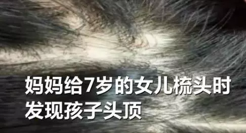 原本想給女兒梳個美美的髮型,不小心用力太猛,孩子就……禿了
