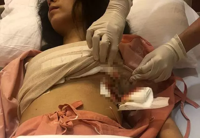 【超噁心】知名女歌手搭飛機「假乳」空中爆炸!胸部變黃色畸形塊!