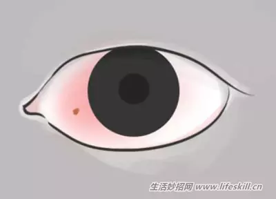花一分鐘觀察一下眼睛,千萬不能輕忽了這10個症狀