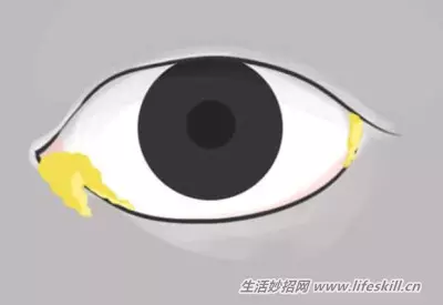 花一分鐘觀察一下眼睛,千萬不能輕忽了這10個症狀